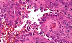 Ung thư nội mô mạch máu ở vị trí hiếm 