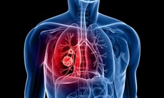 Tình trạng viêm có thể gây khởi phát ung thư phổi ở giai đoạn sớm