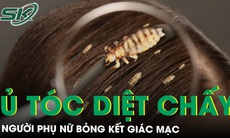 Bỏng kết giác mạc sau khi ủ tóc diệt chấy