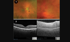 Mất thị lực sau một đêm: Cảnh báo khẩn cấp về tắc động mạch mắt