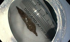 Ăn cháo yến, người phụ nữ bất ngờ bị hạt táo đỏ đâm thủng thành dạ dày