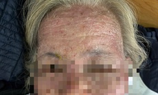 Tưởng có 'sâu bò', người phụ nữ tự điều trị bằng thuốc lá, suýt nguy kịch