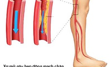 Bệnh động mạch chi dưới ở người cao tuổi dễ nặng lên vào mùa lạnh
