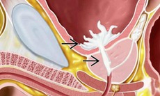 Không thấy tinh dịch sau quan hệ cảnh báo xuất tinh ngược