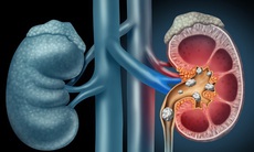  Cách điều trị bệnh sỏi thận đúng cần biết