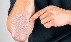 Bệnh vảy nến: dấu hiệu nhận biết và những ai có nguy cơ cao?
