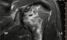 Thợ lặn biển hơn 20 năm bị hoại tử xương cánh tay, xương đùi