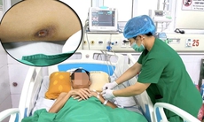 Nam thanh niên mắc Whitmore, áp xe đa tạng