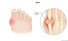 Thiếu vitamin D có thể gây tăng axit uric