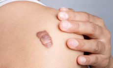 Chữa sẹo lồi có khó không?