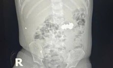 Bé trai nuốt 4 viên đinh nam châm đầu nhọn nguy hiểm
