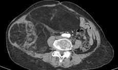 Bụng cụ bà to bất thường, căng tức, bác sĩ phẫu thuật lấy ra khối u ác tính gần 4kg