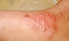 Nhiều trường hợp ở Khánh Hòa bị sán chó, người dân chủ động phòng bệnh