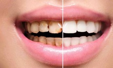 Lợi ích khi lấy cao răng, khi nào không nên lấy cao răng?