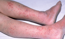 Viêm não mô cầu: Căn bệnh nguy hiểm có thể gây tử vong trong 24 giờ xuất hiện tại Hà Nội