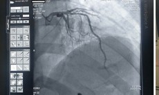 Hồi sinh sự sống cho cụ ông 70 tuổi bị nhồi máu cơ tim cấp trong đêm