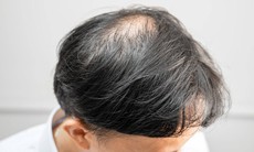 Rụng tóc nhiều vào mùa đông: Bác sĩ chỉ 3 sai lầm khi gội sấy và 4 cách khắc phục