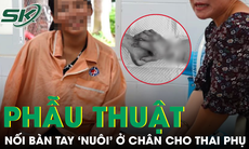 Nối lại bàn tay cho thai phụ mang song thai 34 tuần sau 2 tháng 'nuôi' ở chân