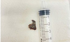 Ho khan nhiều tháng, người đàn ông bất ngờ được phát hiện dị vật mắc sâu trong đường thở