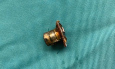 Cụm pin cúc áo trong thực quản bé trai 2 tuổi