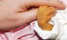 Chiếu đèn điều trị vàng da ở trẻ có hại không?