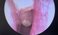 Phẫu thuật thành công cho bệnh nhân polyp mũi hai bên, viêm mũi xoang kèm hàng loạt bệnh lý nền nặng 