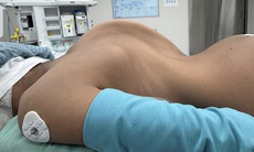 Hành trình nắn lại 'xương sống khủng long' cho hai bé gái