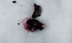 Bác sĩ lấy dị vật vôi hóa tồn tại nhiều năm trong mũi bệnh nhân