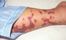 Số ca mắc bệnh do não mô cầu tăng, chuyên gia y tế khuyến cáo gì đến cộng đồng?