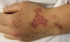 Chuyên gia khuyên gì về căn bệnh truyền nhiễm có thể gây tử vong trong 24h?