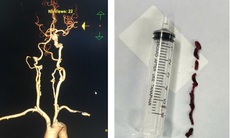 Cứu cụ bà 75 tuổi đột quỵ nhồi máu não thoát lằn ranh sinh tử