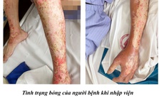 Bỏng nặng khi đốt sofa cũ, người đàn ông vào viện cấp cứu