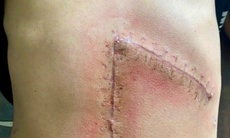 Cứu sống thiếu niên sốc mất máu do vỡ lách độ 5 sau tai nạn giao thông