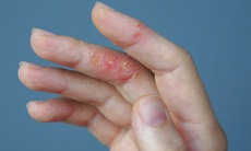 Bệnh viêm da cơ địa tăng nặng khi thời tiết lạnh, khô