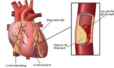 5 biện pháp giảm nguy cơ biến cố tim mạch khi thời tiết lạnh