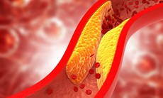 5 lưu ý giúp ngăn ngừa cholesterol cao và phòng tránh đột quỵ