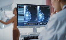 Ai nên chụp nhũ ảnh thường xuyên để phát hiện sớm ung thư vú?