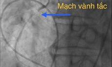 Cứu sống bệnh nhân 70 tuổi vì nhầm nhồi máu cơ tim với 'trúng gió'