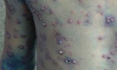 Bệnh thuỷ đậu dễ gặp mùa xuân, cách nhận biết và phòng tránh 