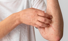 Dị ứng thời tiết: Nguyên nhân, biểu hiện, cách điều trị và phòng bệnh