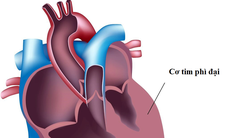 Cơ tim phì đại: Nguyên nhân, biểu hiện, cách điều trị và phòng bệnh