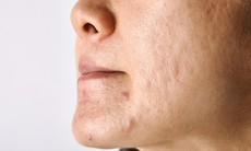Sẹo mụn điều trị thế nào?