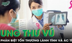 Phân biệt tổn thương lành tính và ác tính trong tầm soát ung thư vú