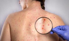 Thai nhi bị ảnh hưởng thế nào nếu người mẹ nhiễm rubella?