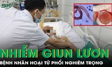 2 bệnh nhân nhiễm giun lươn gây hoại tử phổi nghiêm trọng