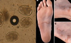 Bệnh nhân loét ruột, tổn thương phổi vì giun lươn: Giun lươn lây nhiễm qua đâu?