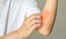 Dị ứng thức ăn làm sao để nhận biết?