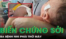 Huế: 3 trẻ nguy kịch, phải thở máy do biến chứng sởi