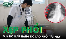 Cứu sống người đàn ông suy hô hấp nặng, xẹp phổi do lao phổi cũ tái phát 