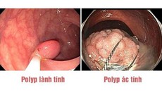 5 triệu chứng cho thấy bạn mắc polyp đại tràng